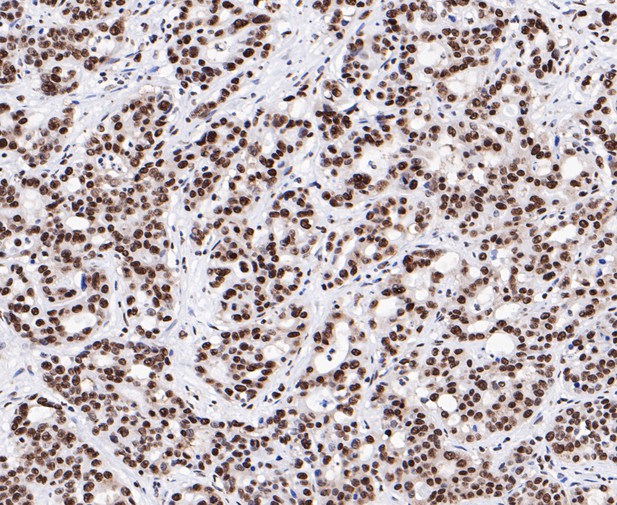 Immunohistochemical analysis of paraffin-embedded human stomach cancer tissue using anti-SAM68 antibody. The section was pre-treated using heat mediated antigen retrieval with sodium citrate buffer (pH 6.0) for 20 minutes. The tissues were blocked in 5% BSA for 30 minutes at room temperature, washed with ddH2O and PBS, and then probed with the primary antibody (ET7109-52, 1/1,000)  for 30 minutes at room temperature. The detection was performed using an HRP conjugated compact polymer system. DAB was used as the chromogen. Tissues were counterstained with hematoxylin and mounted with DPX.