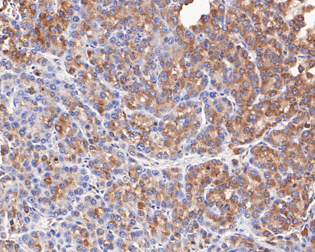 Immunohistochemical analysis of paraffin-embedded human liver cancer tissue using anti-NDUFAF1 antibody. The section was pre-treated using heat mediated antigen retrieval with Tris-EDTA buffer (pH 8.0-8.4) for 20 minutes. The tissues were blocked in 5% BSA for 30 minutes at room temperature, washed with ddH2O and PBS, and then probed with the antibody (ET7109-54) at 1/200 dilution, for 30 minutes at room temperature and detected using an HRP conjugated compact polymer system. DAB was used as the chrogen. Counter stained with hematoxylin and mounted with DPX.