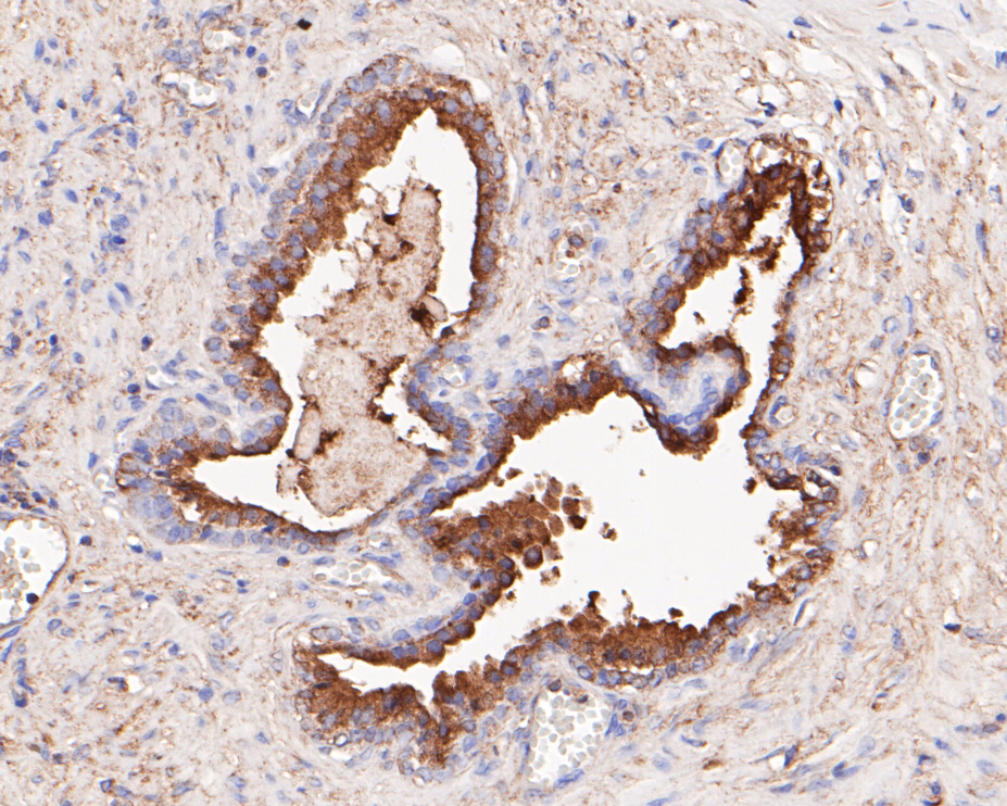 Immunohistochemical analysis of paraffin-embedded human prostate cancer tissue using anti-NDUFAF1 antibody. The section was pre-treated using heat mediated antigen retrieval with Tris-EDTA buffer (pH 8.0-8.4) for 20 minutes. The tissues were blocked in 5% BSA for 30 minutes at room temperature, washed with ddH2O and PBS, and then probed with the antibody (ET7109-54) at 1/200 dilution, for 30 minutes at room temperature and detected using an HRP conjugated compact polymer system. DAB was used as the chrogen. Counter stained with hematoxylin and mounted with DPX.