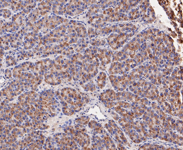 Immunohistochemical analysis of paraffin-embedded human liver cancer tissue using anti-GSTK1 antibody. The section was pre-treated using heat mediated antigen retrieval with Tris-EDTA buffer (pH 8.0-8.4) for 20 minutes.The tissues were blocked in 5% BSA for 30 minutes at room temperature, washed with ddH2O and PBS, and then probed with the primary antibody (ET7109-58, 1/50) for 30 minutes at room temperature. The detection was performed using an HRP conjugated compact polymer system. DAB was used as the chromogen. Tissues were counterstained with hematoxylin and mounted with DPX.