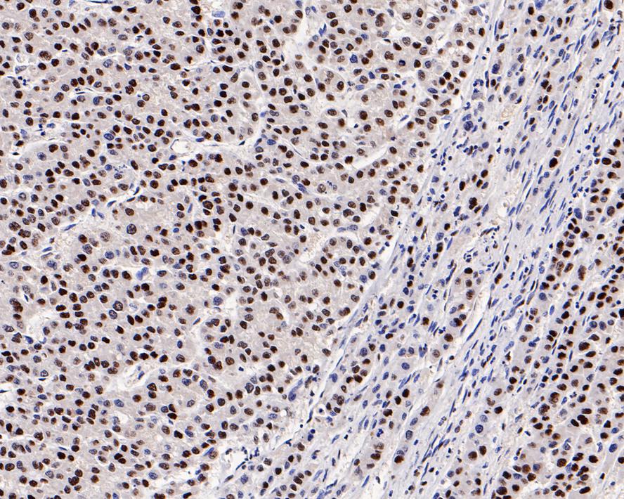 Immunohistochemical analysis of paraffin-embedded human liver carcinoma tissue with Rabbit anti-GTPBP4 antibody (ET7109-59) at 1/500 dilution.<br />
<br />
The section was pre-treated using heat mediated antigen retrieval with sodium citrate buffer (pH 6.0) for 2 minutes. The tissues were blocked in 1% BSA for 20 minutes at room temperature, washed with ddH2O and PBS, and then probed with the primary antibody (ET7109-59) at 1/500 dilution for 1 hour at room temperature. The detection was performed using an HRP conjugated compact polymer system. DAB was used as the chromogen. Tissues were counterstained with hematoxylin and mounted with DPX.