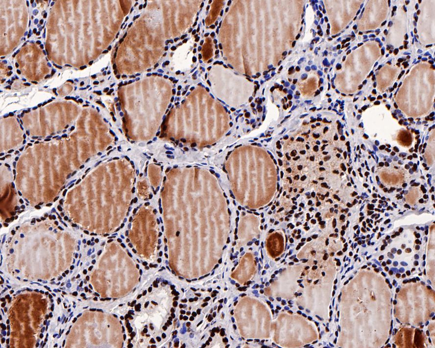 Immunohistochemical analysis of paraffin-embedded human thyroid gland tissue using anti-GTPBP4 antibody. The section was pre-treated using heat mediated antigen retrieval with sodium citrate buffer (pH 6.0) for 20 minutes. The tissues were blocked in 5% BSA for 30 minutes at room temperature, washed with ddH2O and PBS, and then probed with the primary antibody (ET7109-59, 1/50)  for 30 minutes at room temperature. The detection was performed using an HRP conjugated compact polymer system. DAB was used as the chromogen. Tissues were counterstained with hematoxylin and mounted with DPX.