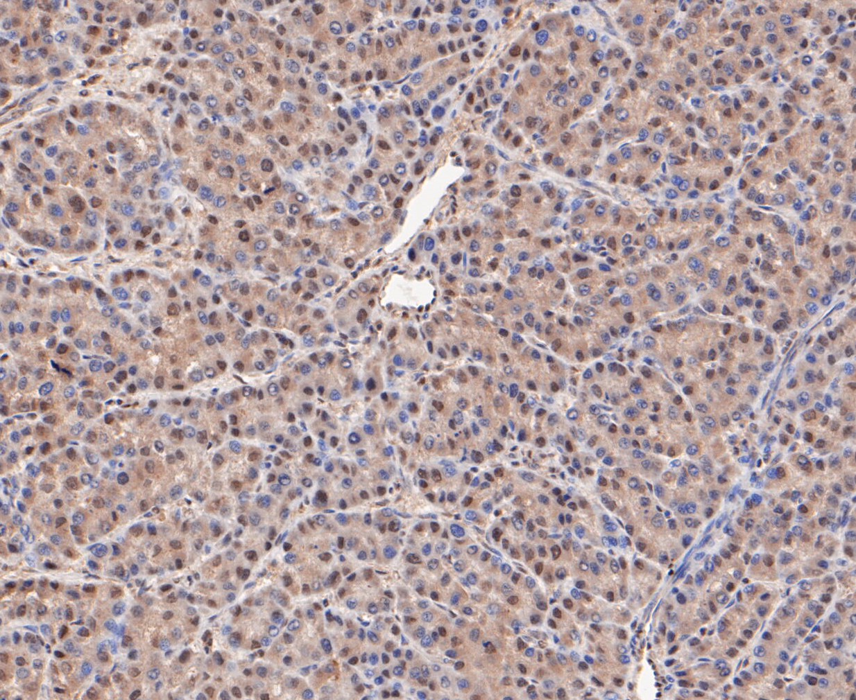 Immunohistochemical analysis of paraffin-embedded human liver cancer tissue using anti-COPS3/CSN3 antibody. The section was pre-treated using heat mediated antigen retrieval with sodium citrate buffer (pH 6.0) for 20 minutes. The tissues were blocked in 5% BSA for 30 minutes at room temperature, washed with ddH2O and PBS, and then probed with the primary antibody (ET7109-60, 1/50)  for 30 minutes at room temperature. The detection was performed using an HRP conjugated compact polymer system. DAB was used as the chromogen. Tissues were counterstained with hematoxylin and mounted with DPX.