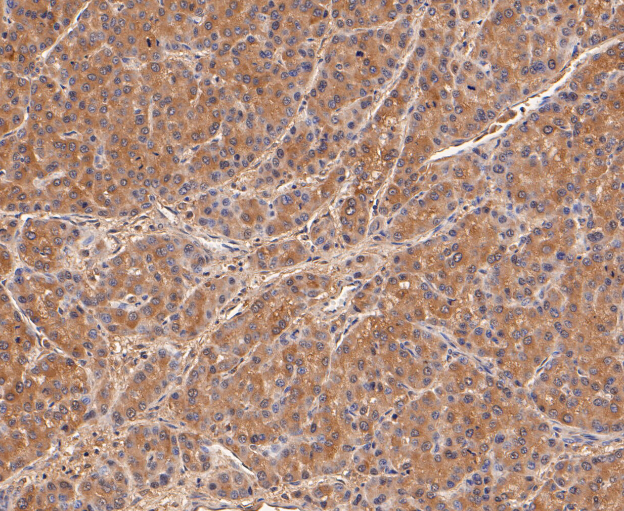 Immunohistochemical analysis of paraffin-embedded human liver cancer tissue using anti-Calpain small subunit 1 antibody. The section was pre-treated using heat mediated antigen retrieval with Tris-EDTA buffer (pH 8.0-8.4) for 20 minutes.The tissues were blocked in 5% BSA for 30 minutes at room temperature, washed with ddH2O and PBS, and then probed with the primary antibody (ET7109-66, 1/50) for 30 minutes at room temperature. The detection was performed using an HRP conjugated compact polymer system. DAB was used as the chromogen. Tissues were counterstained with hematoxylin and mounted with DPX.