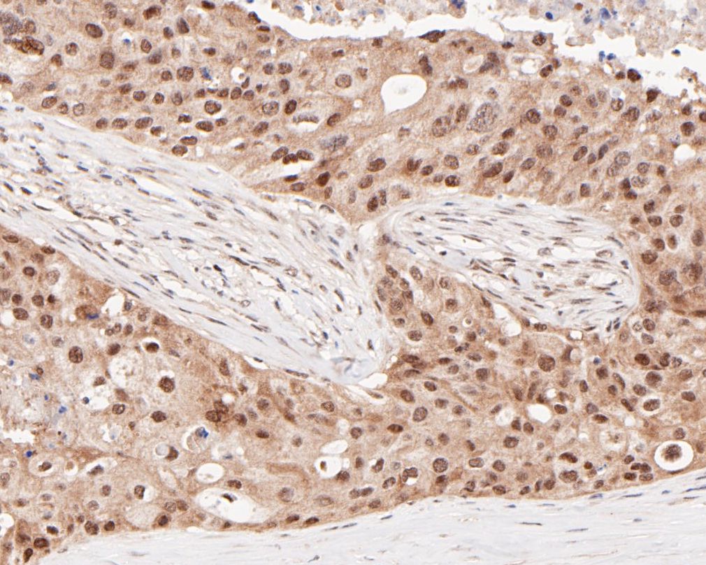 Immunohistochemical analysis of paraffin-embedded human breast cancer tissue using anti-HSF2 antibody. The section was pre-treated using heat mediated antigen retrieval with sodium citrate buffer (pH 6.0) for 20 minutes. The tissues were blocked in 5% BSA for 30 minutes at room temperature, washed with ddH2O and PBS, and then probed with the primary antibody (ET7109-78, 1/50)  for 30 minutes at room temperature. The detection was performed using an HRP conjugated compact polymer system. DAB was used as the chromogen. Tissues were counterstained with hematoxylin and mounted with DPX.
