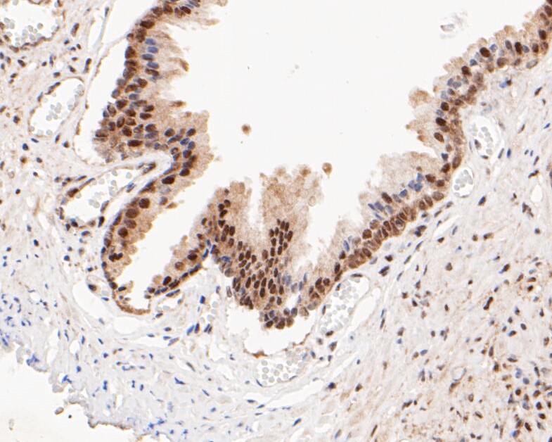 Immunohistochemical analysis of paraffin-embedded human prostate cancer tissue using anti-HSF2 antibody. The section was pre-treated using heat mediated antigen retrieval with sodium citrate buffer (pH 6.0) for 20 minutes. The tissues were blocked in 5% BSA for 30 minutes at room temperature, washed with ddH2O and PBS, and then probed with the primary antibody (ET7109-78, 1/50)  for 30 minutes at room temperature. The detection was performed using an HRP conjugated compact polymer system. DAB was used as the chromogen. Tissues were counterstained with hematoxylin and mounted with DPX.