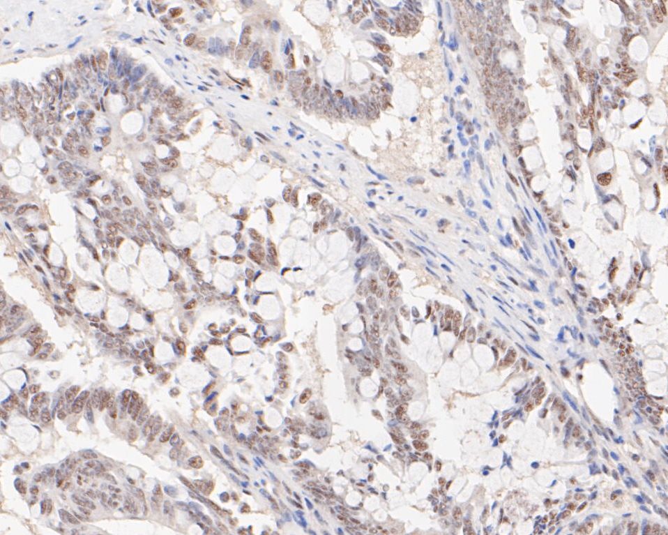 Immunohistochemical analysis of paraffin-embedded human colon cancer tissue using anti-HSF2 antibody. The section was pre-treated using heat mediated antigen retrieval with sodium citrate buffer (pH 6.0) for 20 minutes. The tissues were blocked in 5% BSA for 30 minutes at room temperature, washed with ddH2O and PBS, and then probed with the primary antibody (ET7109-78, 1/50)  for 30 minutes at room temperature. The detection was performed using an HRP conjugated compact polymer system. DAB was used as the chromogen. Tissues were counterstained with hematoxylin and mounted with DPX.
