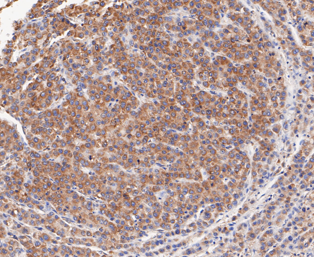Immunohistochemical analysis of paraffin-embedded human liver cancer  tissue using anti-TCP1 alpha/CCTA antibody. The section was pre-treated using heat mediated antigen retrieval with Tris-EDTA buffer (pH 8.0-8.4) for 20 minutes.The tissues were blocked in 5% BSA for 30 minutes at room temperature, washed with ddH2O and PBS, and then probed with the primary antibody (ET7109-79, 1/50) for 30 minutes at room temperature. The detection was performed using an HRP conjugated compact polymer system. DAB was used as the chromogen. Tissues were counterstained with hematoxylin and mounted with DPX.