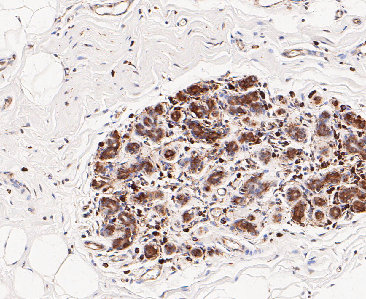 Immunohistochemical analysis of paraffin-embedded human breast tissue using anti-TCP1 alpha/CCTA antibody. The section was pre-treated using heat mediated antigen retrieval with Tris-EDTA buffer (pH 8.0-8.4) for 20 minutes.The tissues were blocked in 5% BSA for 30 minutes at room temperature, washed with ddH2O and PBS, and then probed with the primary antibody (ET7109-79, 1/50) for 30 minutes at room temperature. The detection was performed using an HRP conjugated compact polymer system. DAB was used as the chromogen. Tissues were counterstained with hematoxylin and mounted with DPX.
