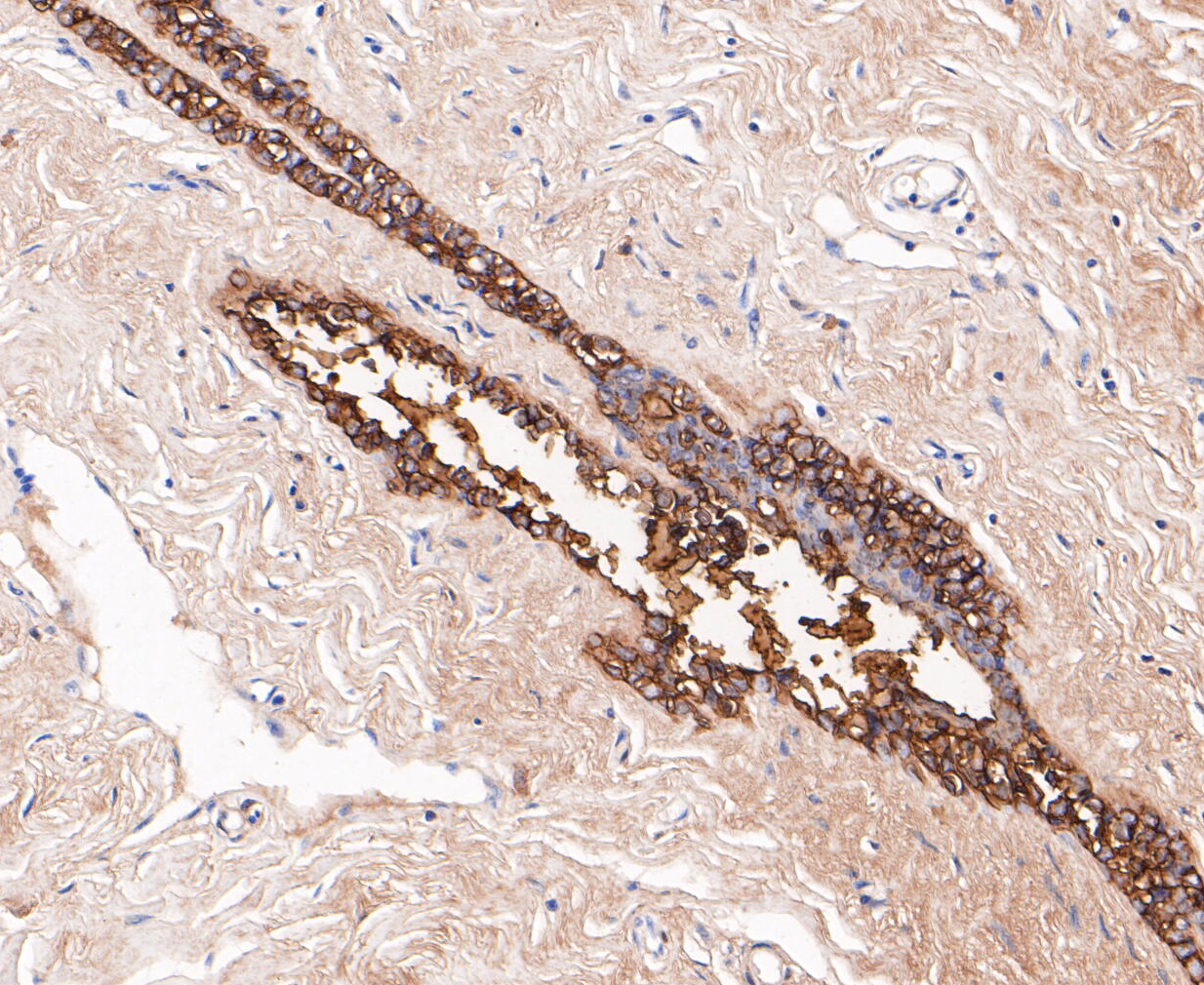 Immunohistochemical analysis of paraffin-embedded human breast tissue using anti-GCDFP 15 antibody. The section was pre-treated using heat mediated antigen retrieval with Tris-EDTA buffer (pH 8.0-8.4) for 20 minutes.The tissues were blocked in 5% BSA for 30 minutes at room temperature, washed with ddH2O and PBS, and then probed with the primary antibody (ET7109-80, 1/200) for 30 minutes at room temperature. The detection was performed using an HRP conjugated compact polymer system. DAB was used as the chromogen. Tissues were counterstained with hematoxylin and mounted with DPX.