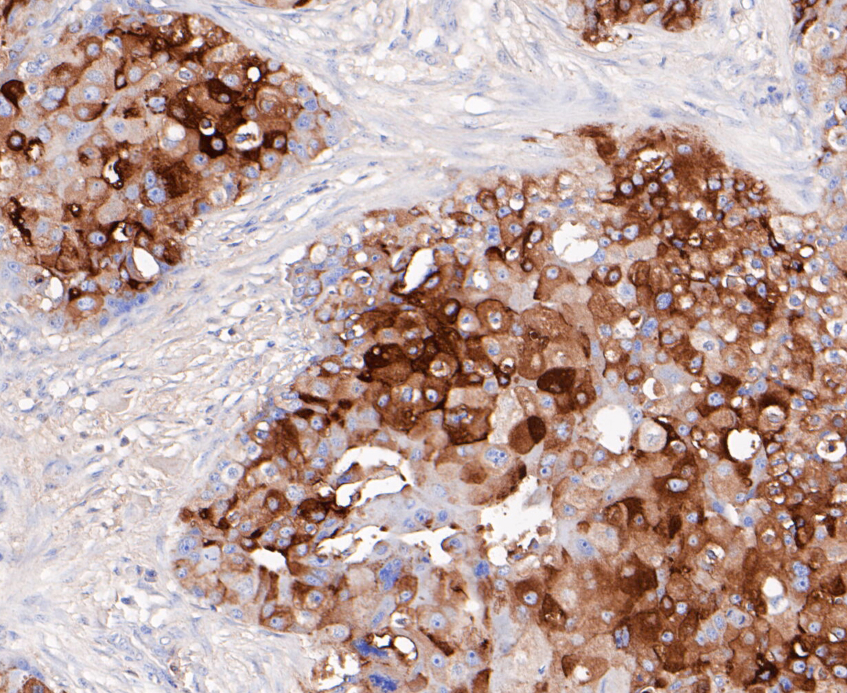 Immunohistochemical analysis of paraffin-embedded human breast cancer tissue using anti-GCDFP 15 antibody. The section was pre-treated using heat mediated antigen retrieval with Tris-EDTA buffer (pH 8.0-8.4) for 20 minutes.The tissues were blocked in 5% BSA for 30 minutes at room temperature, washed with ddH2O and PBS, and then probed with the primary antibody (ET7109-80, 1/200) for 30 minutes at room temperature. The detection was performed using an HRP conjugated compact polymer system. DAB was used as the chromogen. Tissues were counterstained with hematoxylin and mounted with DPX.