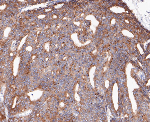 Immunohistochemical analysis of paraffin-embedded human prostate cancer tissue using anti-RSK1 p90 antibody. The section was pre-treated using heat mediated antigen retrieval with sodium citrate buffer (pH 6.0) for 20 minutes. The tissues were blocked in 5% BSA for 30 minutes at room temperature, washed with ddH2O and PBS, and then probed with the primary antibody (ET7109-83, 1/200)  for 30 minutes at room temperature. The detection was performed using an HRP conjugated compact polymer system. DAB was used as the chromogen. Tissues were counterstained with hematoxylin and mounted with DPX.