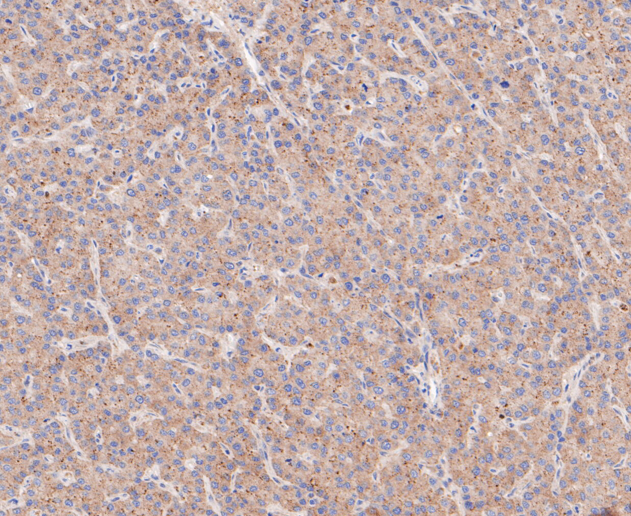 Immunohistochemical analysis of paraffin-embedded human liver cancer tissue using anti-CLSTN1 antibody. The section was pre-treated using heat mediated antigen retrieval with sodium citrate buffer (pH 6.0) for 20 minutes. The tissues were blocked in 5% BSA for 30 minutes at room temperature, washed with ddH2O and PBS, and then probed with the primary antibody (ET7109-84, 1/200)  for 30 minutes at room temperature. The detection was performed using an HRP conjugated compact polymer system. DAB was used as the chromogen. Tissues were counterstained with hematoxylin and mounted with DPX.
