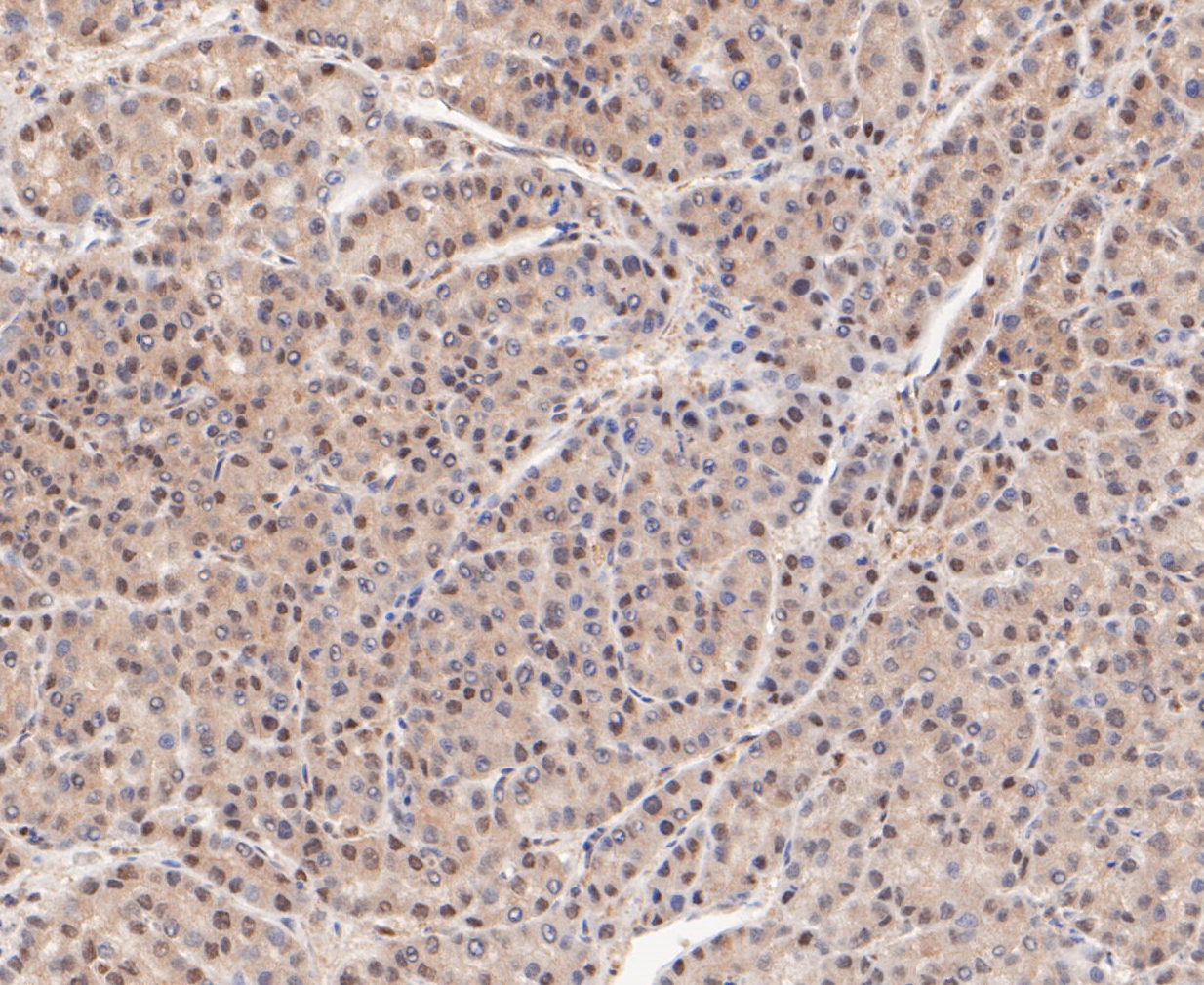 Immunohistochemical analysis of paraffin-embedded human liver cancer tissue using anti-PSMD14 antibody. The section was pre-treated using heat mediated antigen retrieval with sodium citrate buffer (pH 6.0) for 20 minutes. The tissues were blocked in 5% BSA for 30 minutes at room temperature, washed with ddH2O and PBS, and then probed with the primary antibody (ET7109-85, 1/50)  for 30 minutes at room temperature. The detection was performed using an HRP conjugated compact polymer system. DAB was used as the chromogen. Tissues were counterstained with hematoxylin and mounted with DPX.