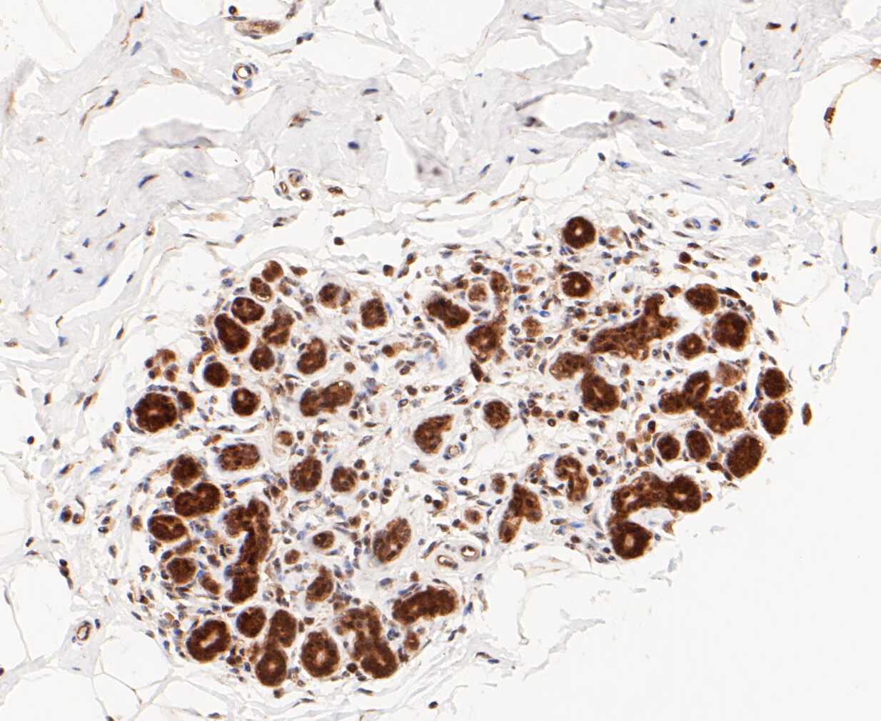 Immunohistochemical analysis of paraffin-embedded human breast tissue using anti-PSMD14 antibody. The section was pre-treated using heat mediated antigen retrieval with sodium citrate buffer (pH 6.0) for 20 minutes. The tissues were blocked in 5% BSA for 30 minutes at room temperature, washed with ddH2O and PBS, and then probed with the primary antibody (ET7109-85, 1/50)  for 30 minutes at room temperature. The detection was performed using an HRP conjugated compact polymer system. DAB was used as the chromogen. Tissues were counterstained with hematoxylin and mounted with DPX.