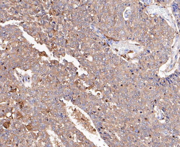 Immunohistochemical analysis of paraffin-embedded human lung cancer tissue using anti-Plastin L antibody. The section was pre-treated using heat mediated antigen retrieval with Tris-EDTA buffer (pH 8.0-8.4) for 20 minutes.The tissues were blocked in 5% BSA for 30 minutes at room temperature, washed with ddH2O and PBS, and then probed with the primary antibody (ET7109-87, 1/200) for 30 minutes at room temperature. The detection was performed using an HRP conjugated compact polymer system. DAB was used as the chromogen. Tissues were counterstained with hematoxylin and mounted with DPX.