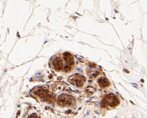 Immunohistochemical analysis of paraffin-embedded human breast tissue using anti-ICAD antibody. The section was pre-treated using heat mediated antigen retrieval with sodium citrate buffer (pH 6.0) for 20 minutes. The tissues were blocked in 5% BSA for 30 minutes at room temperature, washed with ddH2O and PBS, and then probed with the primary antibody (ET7109-91, 1/400)  for 30 minutes at room temperature. The detection was performed using an HRP conjugated compact polymer system. DAB was used as the chromogen. Tissues were counterstained with hematoxylin and mounted with DPX.