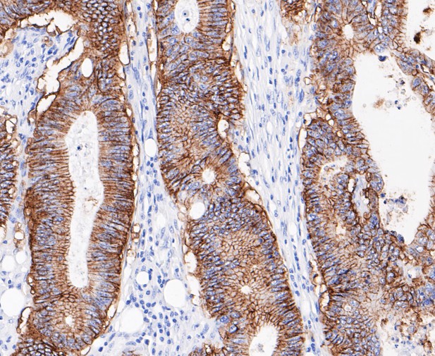 Immunohistochemical analysis of paraffin-embedded human colon cancer tissue using anti-GPA33 antibody. The section was pre-treated using heat mediated antigen retrieval with Tris-EDTA buffer (pH 8.0-8.4) for 20 minutes.The tissues were blocked in 5% BSA for 30 minutes at room temperature, washed with ddH2O and PBS, and then probed with the primary antibody (ET7109-93, 1/200) for 30 minutes at room temperature. The detection was performed using an HRP conjugated compact polymer system. DAB was used as the chromogen. Tissues were counterstained with hematoxylin and mounted with DPX.