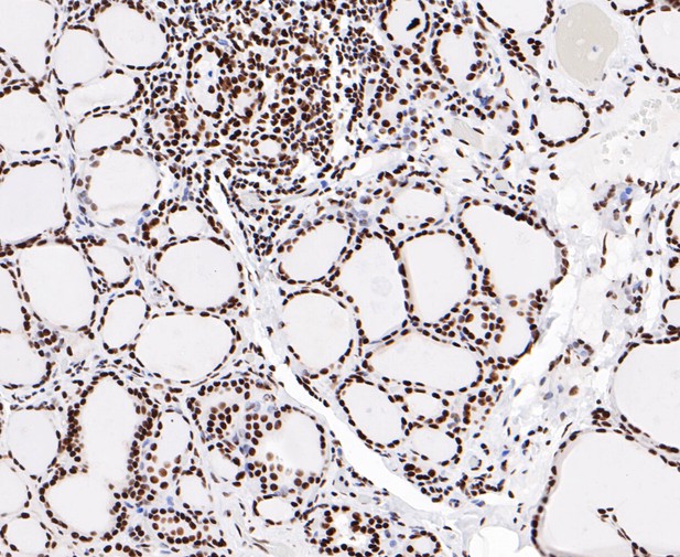 Immunohistochemical analysis of paraffin-embedded human thyroid gland tissue using anti-EWSR1/EWS antibody. The section was pre-treated using heat mediated antigen retrieval with sodium citrate buffer (pH 6.0) for 20 minutes. The tissues were blocked in 5% BSA for 30 minutes at room temperature, washed with ddH2O and PBS, and then probed with the primary antibody (ET7109-94, 1/50)  for 30 minutes at room temperature. The detection was performed using an HRP conjugated compact polymer system. DAB was used as the chromogen. Tissues were counterstained with hematoxylin and mounted with DPX.