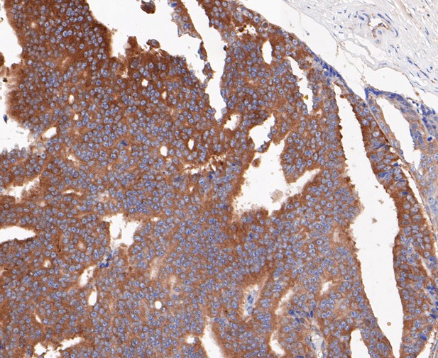 Immunohistochemical analysis of paraffin-embedded human prostate cancer tissue using anti-Lactoferrin antibody. The section was pre-treated using heat mediated antigen retrieval with sodium citrate buffer (pH 6.0) for 20 minutes. The tissues were blocked in 5% BSA for 30 minutes at room temperature, washed with ddH2O and PBS, and then probed with the primary antibody (ET7109-95, 1/200)  for 30 minutes at room temperature. The detection was performed using an HRP conjugated compact polymer system. DAB was used as the chromogen. Tissues were counterstained with hematoxylin and mounted with DPX.