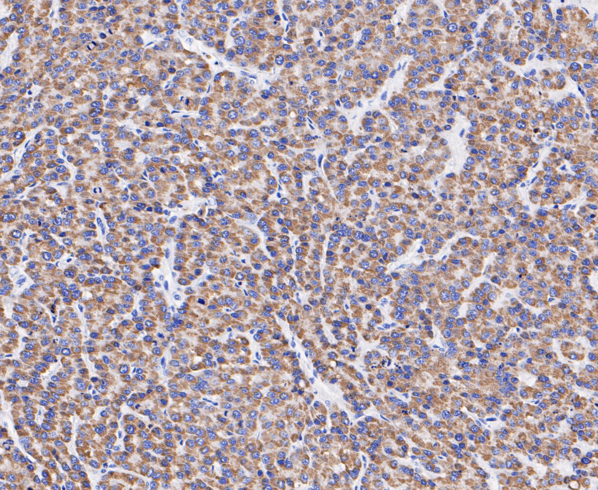 Immunohistochemical analysis of paraffin-embedded human liver cancer tissue using anti-ABAT/GABA-T antibody. The section was pre-treated using heat mediated antigen retrieval with Tris-EDTA buffer (pH 8.0-8.4) for 20 minutes.The tissues were blocked in 5% BSA for 30 minutes at room temperature, washed with ddH2O and PBS, and then probed with the primary antibody (ET7110-01, 1/200) for 1 hour at room temperature. The detection was performed using an HRP conjugated compact polymer system. DAB was used as the chromogen. Tissues were counterstained with hematoxylin and mounted with DPX.