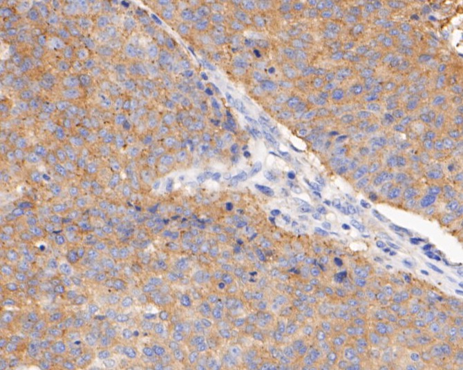 Immunohistochemical analysis of paraffin-embedded human lung carcinoma tissue using anti-BCL2L12 antibody. The section was pre-treated using heat mediated antigen retrieval with sodium citrate buffer (pH 6.0) for 20 minutes. The tissues were blocked in 5% BSA for 30 minutes at room temperature, washed with ddH2O and PBS, and then probed with the primary antibody (ET7110-02, 1/400)  for 30 minutes at room temperature. The detection was performed using an HRP conjugated compact polymer system. DAB was used as the chromogen. Tissues were counterstained with hematoxylin and mounted with DPX.