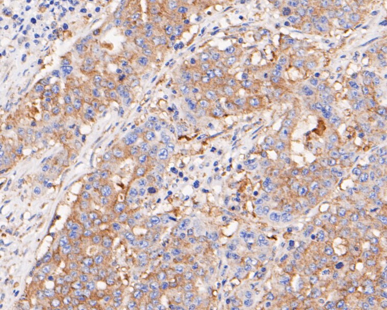 Immunohistochemical analysis of paraffin-embedded human gastric carcinoma tissue using anti-BCL2L12 antibody. The section was pre-treated using heat mediated antigen retrieval with sodium citrate buffer (pH 6.0) for 20 minutes. The tissues were blocked in 5% BSA for 30 minutes at room temperature, washed with ddH2O and PBS, and then probed with the primary antibody (ET7110-02, 1/800)  for 30 minutes at room temperature. The detection was performed using an HRP conjugated compact polymer system. DAB was used as the chromogen. Tissues were counterstained with hematoxylin and mounted with DPX.