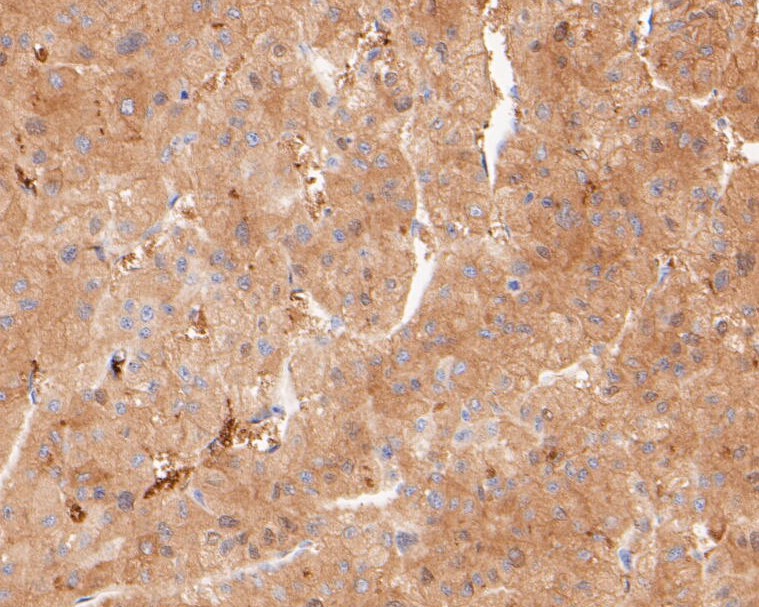 Immunohistochemical analysis of paraffin-embedded human liver tissue using anti-FBP1 antibody. The section was pre-treated using heat mediated antigen retrieval with sodium citrate buffer (pH 6.0) for 20 minutes. The tissues were blocked in 5% BSA for 30 minutes at room temperature, washed with ddH2O and PBS, and then probed with the primary antibody (ET7110-07, 1/200)  for 30 minutes at room temperature. The detection was performed using an HRP conjugated compact polymer system. DAB was used as the chromogen. Tissues were counterstained with hematoxylin and mounted with DPX.