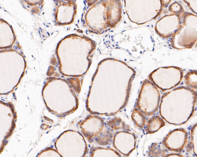 Immunohistochemical analysis of paraffin-embedded human thyroid carcinoma tissue using anti-FBP1 antibody. The section was pre-treated using heat mediated antigen retrieval with sodium citrate buffer (pH 6.0) for 20 minutes. The tissues were blocked in 5% BSA for 30 minutes at room temperature, washed with ddH2O and PBS, and then probed with the primary antibody (ET7110-07, 1/200)  for 30 minutes at room temperature. The detection was performed using an HRP conjugated compact polymer system. DAB was used as the chromogen. Tissues were counterstained with hematoxylin and mounted with DPX.