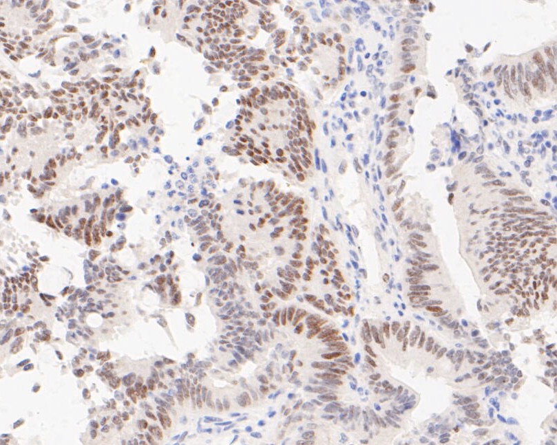 Immunohistochemical analysis of paraffin-embedded human colon carcinoma tissue using anti-G9a antibody. The section was pre-treated using heat mediated antigen retrieval with sodium citrate buffer (pH 6.0) for 20 minutes. The tissues were blocked in 5% BSA for 30 minutes at room temperature, washed with ddH2O and PBS, and then probed with the primary antibody (ET7110-08, 1/50)  for 30 minutes at room temperature. The detection was performed using an HRP conjugated compact polymer system. DAB was used as the chromogen. Tissues were counterstained with hematoxylin and mounted with DPX.