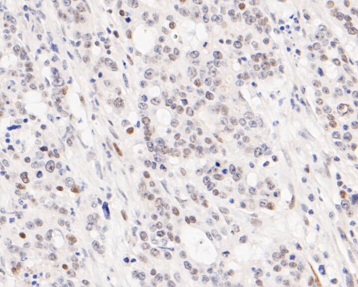Immunohistochemical analysis of paraffin-embedded human gastric carcinoma tissue using anti-G9a antibody. The section was pre-treated using heat mediated antigen retrieval with sodium citrate buffer (pH 6.0) for 20 minutes. The tissues were blocked in 5% BSA for 30 minutes at room temperature, washed with ddH2O and PBS, and then probed with the primary antibody (ET7110-08, 1/50)  for 30 minutes at room temperature. The detection was performed using an HRP conjugated compact polymer system. DAB was used as the chromogen. Tissues were counterstained with hematoxylin and mounted with DPX.