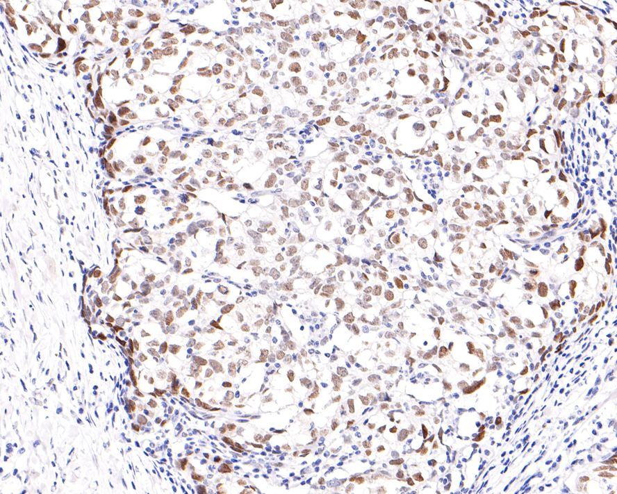 Immunohistochemical analysis of paraffin-embedded human breast carcinoma tissue with Rabbit anti-G9a antibody (ET7110-08) at 1/400 dilution.<br />
<br />
The section was pre-treated using heat mediated antigen retrieval with sodium citrate buffer (pH 6.0) for 2 minutes. The tissues were blocked in 1% BSA for 20 minutes at room temperature, washed with ddH2O and PBS, and then probed with the primary antibody (ET7110-08) at 1/400 dilution for 1 hour at room temperature. The detection was performed using an HRP conjugated compact polymer system. DAB was used as the chromogen. Tissues were counterstained with hematoxylin and mounted with DPX.