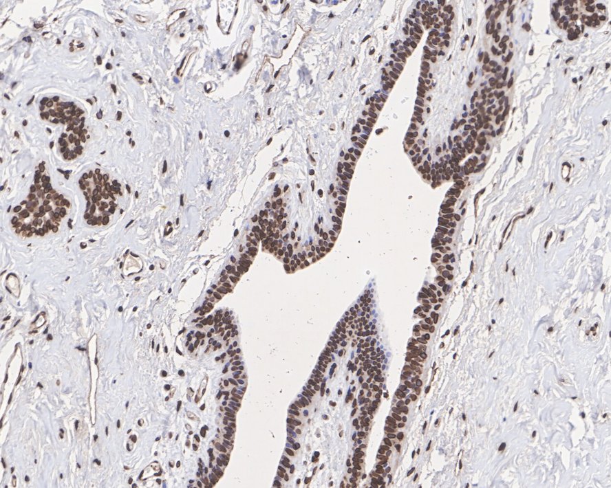 Immunohistochemical analysis of paraffin-embedded human colon carcinoma tissue using anti-Lamin A/C antibody. The section was pre-treated using heat mediated antigen retrieval with sodium citrate buffer (pH 6.0) for 20 minutes. The tissues were blocked in 5% BSA for 30 minutes at room temperature, washed with ddH2O and PBS, and then probed with the primary antibody (ET7110-12, 1/50)  for 30 minutes at room temperature. The detection was performed using an HRP conjugated compact polymer system. DAB was used as the chromogen. Tissues were counterstained with hematoxylin and mounted with DPX.