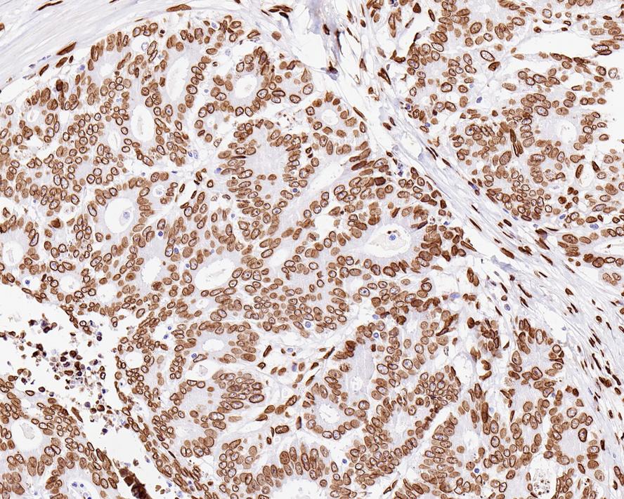 Immunohistochemical analysis of paraffin-embedded human breast tissue using anti-Lamin A/C antibody. The section was pre-treated using heat mediated antigen retrieval with sodium citrate buffer (pH 6.0) for 20 minutes. The tissues were blocked in 5% BSA for 30 minutes at room temperature, washed with ddH2O and PBS, and then probed with the primary antibody (ET7110-12, 1/50)  for 30 minutes at room temperature. The detection was performed using an HRP conjugated compact polymer system. DAB was used as the chromogen. Tissues were counterstained with hematoxylin and mounted with DPX.