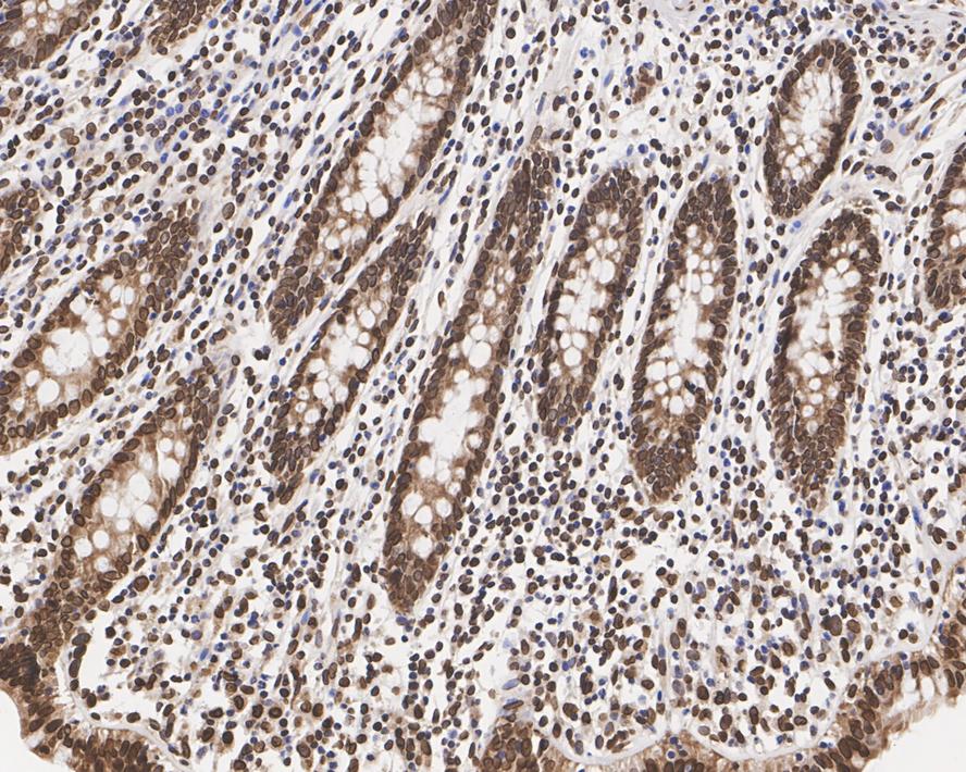 Immunohistochemical analysis of paraffin-embedded human  gastric carcinoma tissue using anti-Lamin A/C antibody. The section was pre-treated using heat mediated antigen retrieval with sodium citrate buffer (pH 6.0) for 20 minutes. The tissues were blocked in 5% BSA for 30 minutes at room temperature, washed with ddH2O and PBS, and then probed with the primary antibody (ET7110-12, 1/50)  for 30 minutes at room temperature. The detection was performed using an HRP conjugated compact polymer system. DAB was used as the chromogen. Tissues were counterstained with hematoxylin and mounted with DPX.