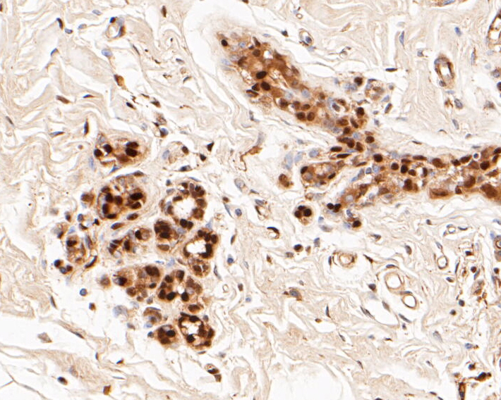 Immunohistochemical analysis of paraffin-embedded human breast tissue using anti-LTA4H antibody. The section was pre-treated using heat mediated antigen retrieval with sodium citrate buffer (pH 6.0) for 20 minutes. The tissues were blocked in 5% BSA for 30 minutes at room temperature, washed with ddH2O and PBS, and then probed with the primary antibody (ET7110-13, 1/50)  for 30 minutes at room temperature. The detection was performed using an HRP conjugated compact polymer system. DAB was used as the chromogen. Tissues were counterstained with hematoxylin and mounted with DPX.
