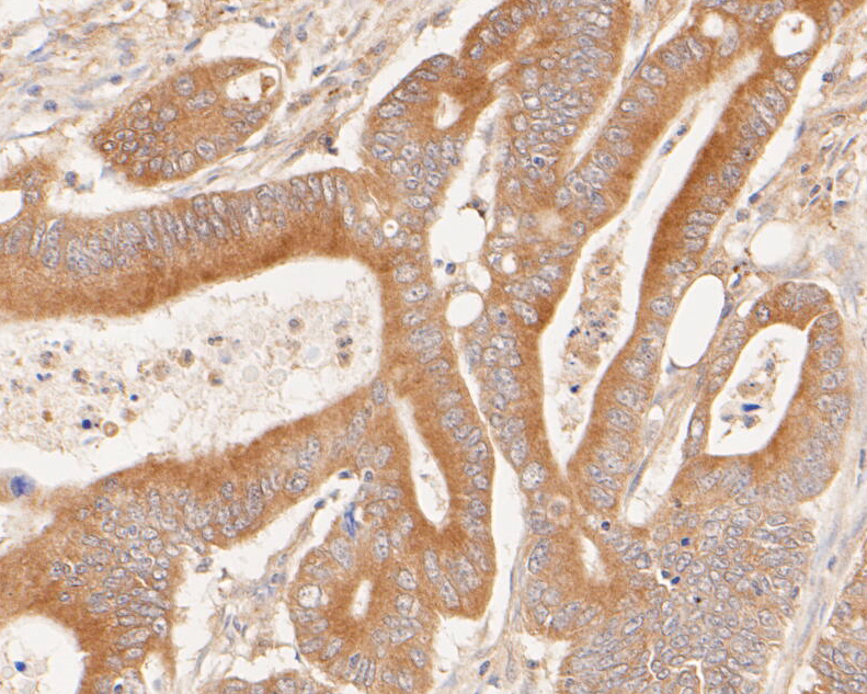 Immunohistochemical analysis of paraffin-embedded human colon carcinoma tissue using anti-Phospho-Met  (pY1349) antibody. The section was pre-treated using heat mediated antigen retrieval with Tris-EDTA buffer (pH 8.0-8.4) for 20 minutes.The tissues were blocked in 5% BSA for 30 minutes at room temperature, washed with ddH2O and PBS, and then probed with the primary antibody (ET7110-14, 1/50) for 30 minutes at room temperature. The detection was performed using an HRP conjugated compact polymer system. DAB was used as the chromogen. Tissues were counterstained with hematoxylin and mounted with DPX.