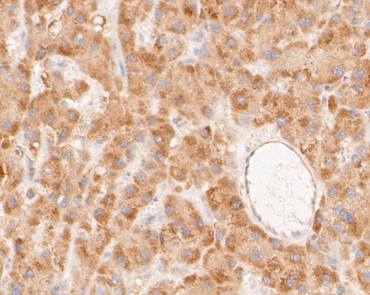 Immunohistochemical analysis of paraffin-embedded human liver carcinoma tissue using anti-NEK7 antibody. The section was pre-treated using heat mediated antigen retrieval with sodium citrate buffer (pH 6.0) for 20 minutes. The tissues were blocked in 5% BSA for 30 minutes at room temperature, washed with ddH2O and PBS, and then probed with the primary antibody (ET7110-16, 1/200)  for 30 minutes at room temperature. The detection was performed using an HRP conjugated compact polymer system. DAB was used as the chromogen. Tissues were counterstained with hematoxylin and mounted with DPX.