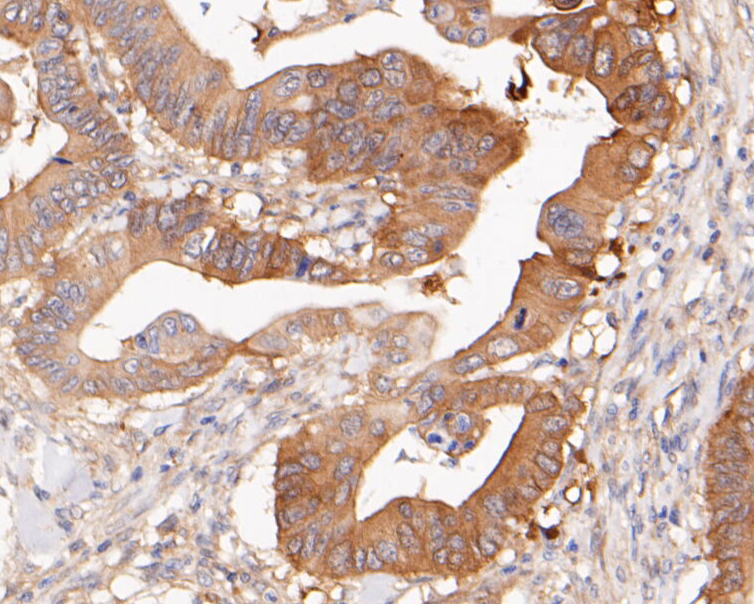 Immunohistochemical analysis of paraffin-embedded human colon carcinoma tissue using anti-NUDC antibody. The section was pre-treated using heat mediated antigen retrieval with sodium citrate buffer (pH 6.0) for 20 minutes. The tissues were blocked in 5% BSA for 30 minutes at room temperature, washed with ddH2O and PBS, and then probed with the primary antibody (ET7110-18, 1/200)  for 30 minutes at room temperature. The detection was performed using an HRP conjugated compact polymer system. DAB was used as the chromogen. Tissues were counterstained with hematoxylin and mounted with DPX.