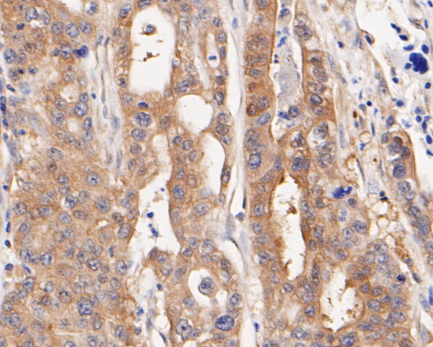 Immunohistochemical analysis of paraffin-embedded human gastric carcinoma tissue using anti-NUDC antibody. The section was pre-treated using heat mediated antigen retrieval with sodium citrate buffer (pH 6.0) for 20 minutes. The tissues were blocked in 5% BSA for 30 minutes at room temperature, washed with ddH2O and PBS, and then probed with the primary antibody (ET7110-18, 1/200)  for 30 minutes at room temperature. The detection was performed using an HRP conjugated compact polymer system. DAB was used as the chromogen. Tissues were counterstained with hematoxylin and mounted with DPX.