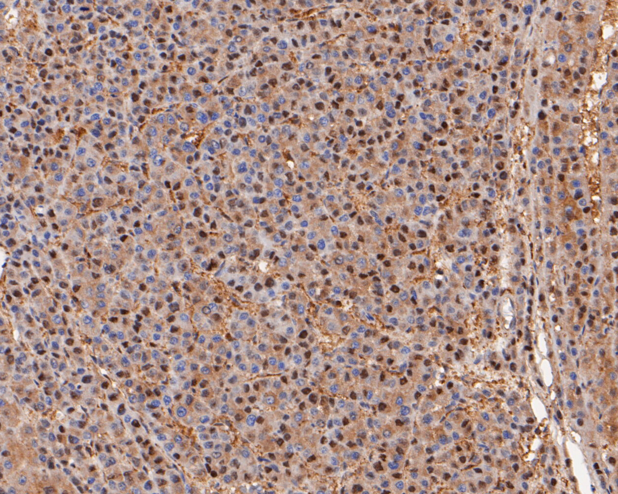 Immunohistochemical analysis of paraffin-embedded human liver carcinoma tissue using anti-PSMA2 antibody. The section was pre-treated using heat mediated antigen retrieval with sodium citrate buffer (pH 6.0) for 20 minutes. The tissues were blocked in 5% BSA for 30 minutes at room temperature, washed with ddH2O and PBS, and then probed with the primary antibody (ET7110-19, 1/200)  for 30 minutes at room temperature. The detection was performed using an HRP conjugated compact polymer system. DAB was used as the chromogen. Tissues were counterstained with hematoxylin and mounted with DPX.