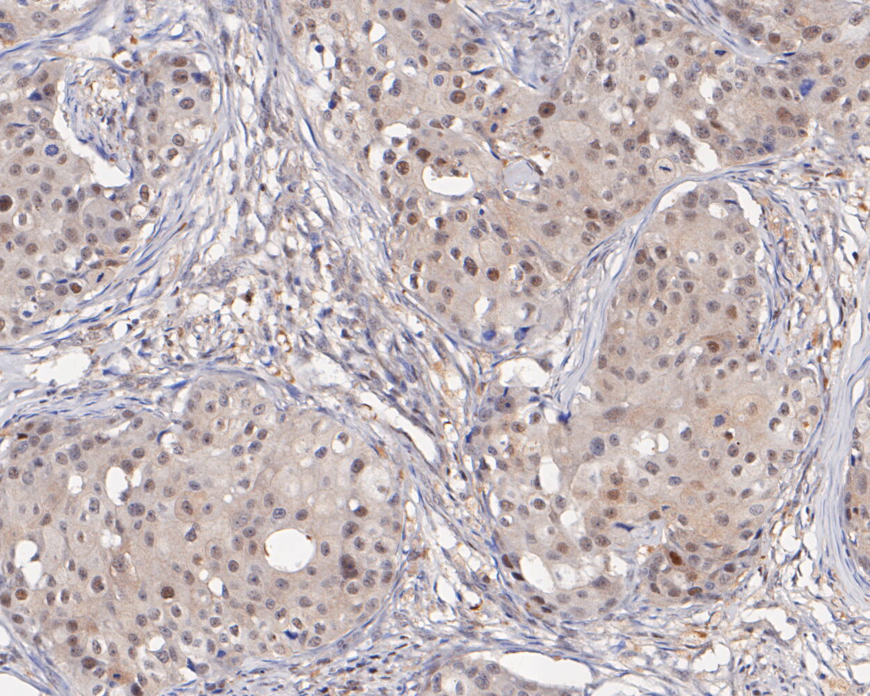 Immunohistochemical analysis of paraffin-embedded human breast carcinoma tissue using anti-PSMA2 antibody. The section was pre-treated using heat mediated antigen retrieval with sodium citrate buffer (pH 6.0) for 20 minutes. The tissues were blocked in 5% BSA for 30 minutes at room temperature, washed with ddH2O and PBS, and then probed with the primary antibody (ET7110-19, 1/200)  for 30 minutes at room temperature. The detection was performed using an HRP conjugated compact polymer system. DAB was used as the chromogen. Tissues were counterstained with hematoxylin and mounted with DPX.