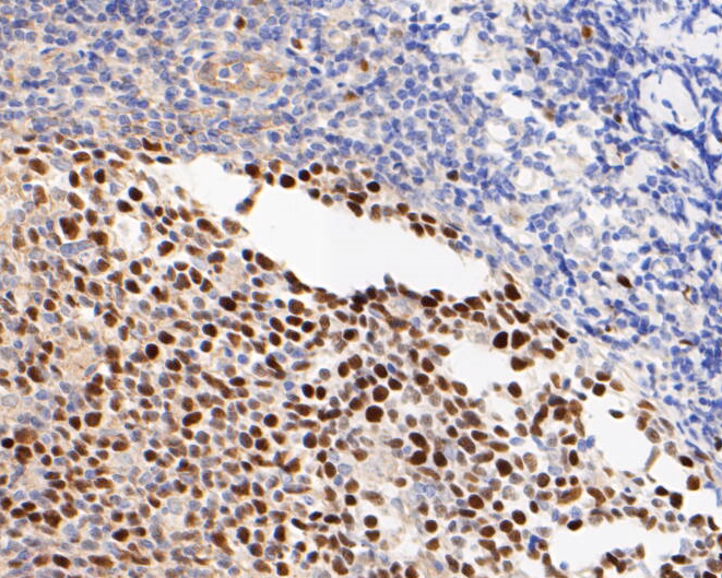 Immunohistochemical analysis of paraffin-embedded human tonsil tissue using anti-Timeless antibody. The section was pre-treated using heat mediated antigen retrieval with sodium citrate buffer (pH 6.0) for 20 minutes. The tissues were blocked in 5% BSA for 30 minutes at room temperature, washed with ddH2O and PBS, and then probed with the primary antibody (ET7110-23, 1/50)  for 30 minutes at room temperature. The detection was performed using an HRP conjugated compact polymer system. DAB was used as the chromogen. Tissues were counterstained with hematoxylin and mounted with DPX.