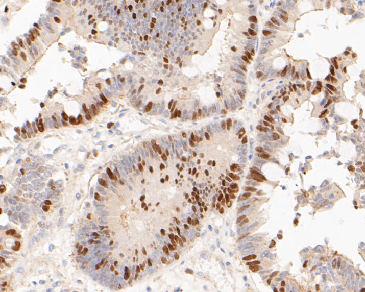 Immunohistochemical analysis of paraffin-embedded human colon carcinoma tissue using anti-Timeless antibody. The section was pre-treated using heat mediated antigen retrieval with sodium citrate buffer (pH 6.0) for 20 minutes. The tissues were blocked in 5% BSA for 30 minutes at room temperature, washed with ddH2O and PBS, and then probed with the primary antibody (ET7110-23, 1/50)  for 30 minutes at room temperature. The detection was performed using an HRP conjugated compact polymer system. DAB was used as the chromogen. Tissues were counterstained with hematoxylin and mounted with DPX.