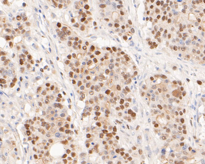 Immunohistochemical analysis of paraffin-embedded human gastric carcinoma tissue using anti-Timeless antibody. The section was pre-treated using heat mediated antigen retrieval with sodium citrate buffer (pH 6.0) for 20 minutes. The tissues were blocked in 5% BSA for 30 minutes at room temperature, washed with ddH2O and PBS, and then probed with the primary antibody (ET7110-23, 1/50)  for 30 minutes at room temperature. The detection was performed using an HRP conjugated compact polymer system. DAB was used as the chromogen. Tissues were counterstained with hematoxylin and mounted with DPX.