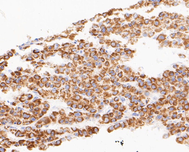 Immunohistochemical analysis of paraffin-embedded human liver carcinoma tissue using anti-TIMM50 (Tim50) antibody. The section was pre-treated using heat mediated antigen retrieval with sodium citrate buffer (pH 6.0) for 20 minutes. The tissues were blocked in 5% BSA for 30 minutes at room temperature, washed with ddH2O and PBS, and then probed with the primary antibody (ET7110-24, 1/50)  for 30 minutes at room temperature. The detection was performed using an HRP conjugated compact polymer system. DAB was used as the chromogen. Tissues were counterstained with hematoxylin and mounted with DPX.
