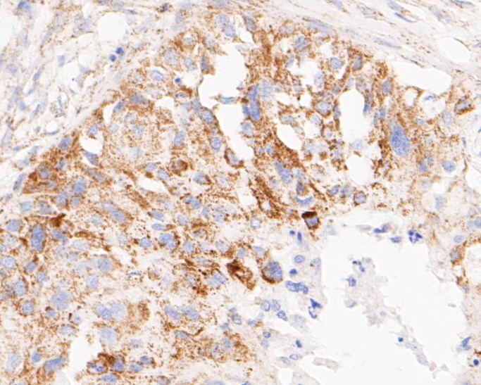 Immunohistochemical analysis of paraffin-embedded human breast carcinoma tissue using anti-TIMM50 (Tim50) antibody. The section was pre-treated using heat mediated antigen retrieval with sodium citrate buffer (pH 6.0) for 20 minutes. The tissues were blocked in 5% BSA for 30 minutes at room temperature, washed with ddH2O and PBS, and then probed with the primary antibody (ET7110-24, 1/50)  for 30 minutes at room temperature. The detection was performed using an HRP conjugated compact polymer system. DAB was used as the chromogen. Tissues were counterstained with hematoxylin and mounted with DPX.