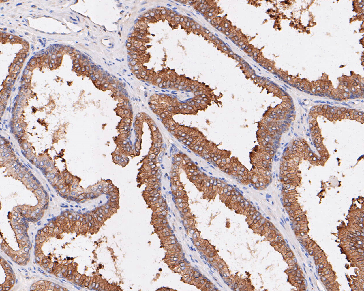 Immunohistochemical analysis of paraffin-embedded human prostate carcinoma tissue using anti-SPAK antibody. The section was pre-treated using heat mediated antigen retrieval with sodium citrate buffer (pH 6.0) for 20 minutes. The tissues were blocked in 5% BSA for 30 minutes at room temperature, washed with ddH2O and PBS, and then probed with the primary antibody (ET7110-37, 1/50)  for 30 minutes at room temperature. The detection was performed using an HRP conjugated compact polymer system. DAB was used as the chromogen. Tissues were counterstained with hematoxylin and mounted with DPX.