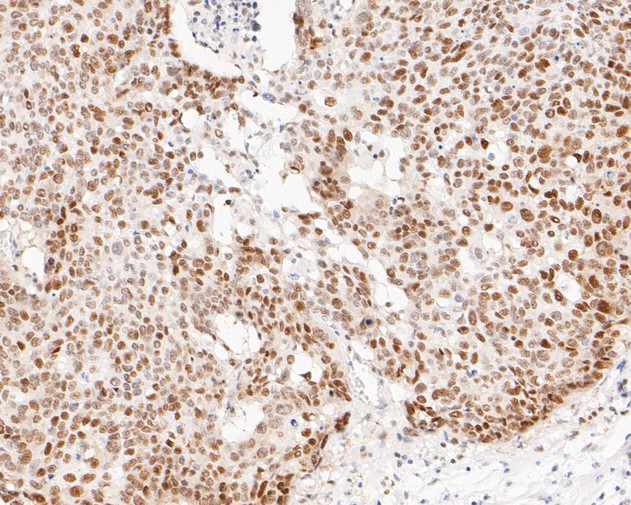 Immunohistochemical analysis of paraffin-embedded human lung carcinoma tissue using anti-DP1 antibody. The section was pre-treated using heat mediated antigen retrieval with sodium citrate buffer (pH 6.0) for 20 minutes. The tissues were blocked in 5% BSA for 30 minutes at room temperature, washed with ddH2O and PBS, and then probed with the primary antibody (ET7110-43, 1/200)  for 30 minutes at room temperature. The detection was performed using an HRP conjugated compact polymer system. DAB was used as the chromogen. Tissues were counterstained with hematoxylin and mounted with DPX.
