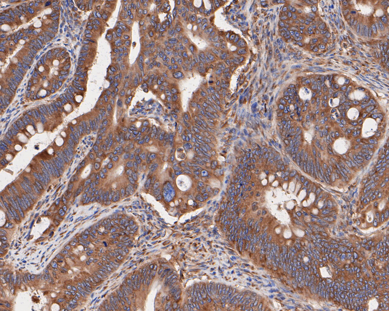 Immunohistochemical analysis of paraffin-embedded human colon carcinoma tissue using anti-Elongation factor 1-gamma antibody. The section was pre-treated using heat mediated antigen retrieval with sodium citrate buffer (pH 6.0) for 20 minutes. The tissues were blocked in 5% BSA for 30 minutes at room temperature, washed with ddH2O and PBS, and then probed with the primary antibody (ET7110-45, 1/400)  for 30 minutes at room temperature. The detection was performed using an HRP conjugated compact polymer system. DAB was used as the chromogen. Tissues were counterstained with hematoxylin and mounted with DPX.